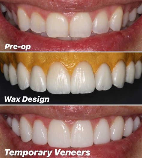 what are the cheapest veneers total
